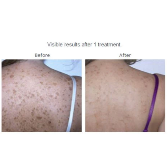 Adena IPL Hair Removal & Skin Rejuvenation ST LCD G+ image 2